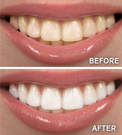 teeth whitening dental care of mesa dentist in mesa az